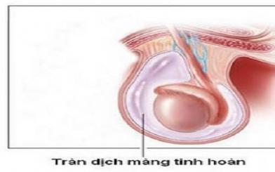 Viêm tinh hoàn tràn dịch: Nguyên nhân, triệu chứng, cách điều trị