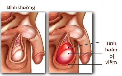 [Góc tư vấn] Khi bị viêm tinh hoàn phải làm sao? 