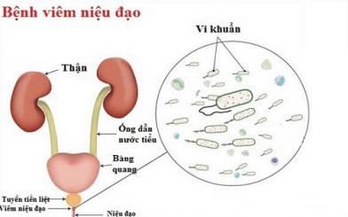 Niệu đạo bị viêm ở nam và nữ giới có nguy hiểm?