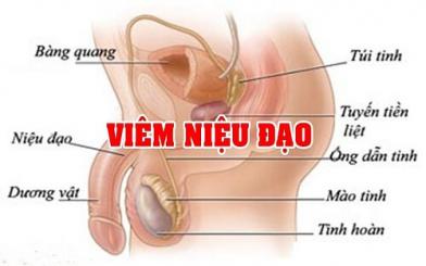 Viêm niệu đạo không đặc hiệu và cách chữa hiệu quả