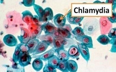 Viêm niệu đạo Chlamydia là gì? Cách khắc phục triệt để