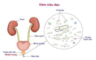 Viêm niệu đạo cấp: Dấu hiệu, chẩn đoán và cách chữa hiệu quả