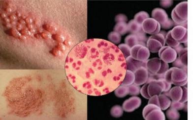 Viêm niệu đạo lậu là bệnh gì? Cách điều trị tích cực
