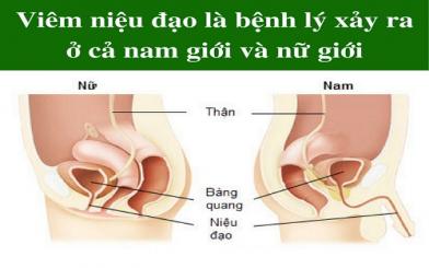 5 cách phòng tránh viêm niệu đạo hiệu quả, đơn giản