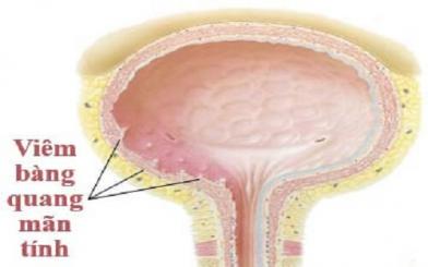 Những thông tin cần biết về viêm bàng quang mãn tính