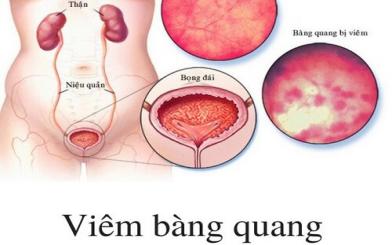 Chớ chủ quan với triệu chứng viêm bàng quang tiểu ra máu!