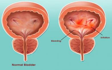 Viêm bàng quang biến chứng gì? [5 biến chứng nguy hiểm]