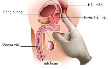 Các bệnh về tuyến tiền liệt và cách điều trị tại nhà