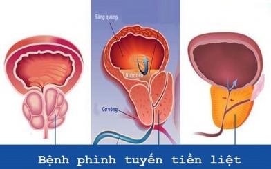 Bệnh phình tuyến tiền liệt là gì? Chữa khỏi không?