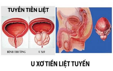 10 nguyên nhân bệnh u xơ tuyến tiền liệt và cách điều trị