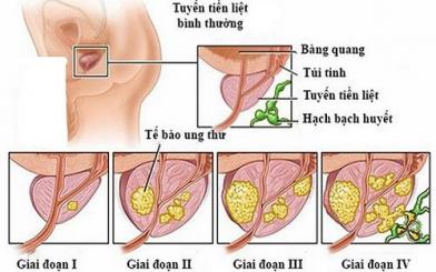Các dấu hiệu bệnh ung thư tuyến tiền liệt điển hình