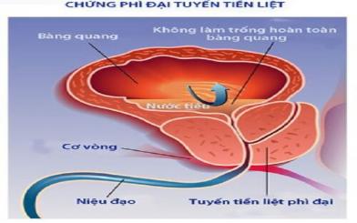 Các biến chứng của u phì đại tuyến tiền liệt điển hình