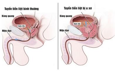 [Giải đáp] Bệnh u xơ tuyến tiền liệt có nguy hiểm không?