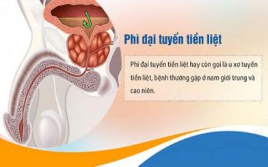 Bệnh phì đại tuyến tiền liệt : Nguyên nhân, triệu chứng và cách điều trị bệnh hiệu quả