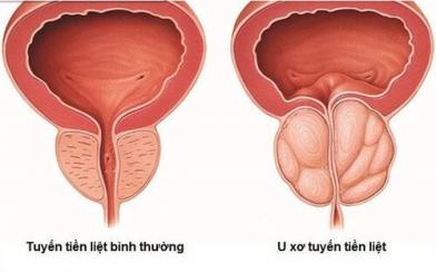 Cách chữa bệnh u xơ tuyến tiền liệt bằng thuốc có tốt?