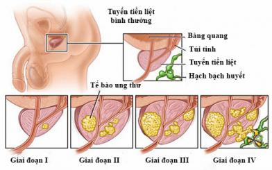 Giai đoạn cuối bệnh ung thư tuyến tiền liệt có chữa được không?