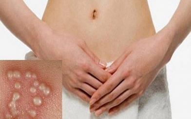 Mụn rộp sinh dục ở nữ có nguy hiểm không & cách chữa hiệu quả nhất