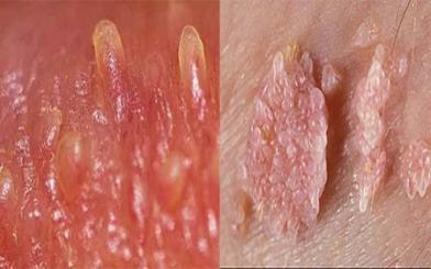 Hình ảnh gai sinh dục phân biệt với các bệnh lý khác