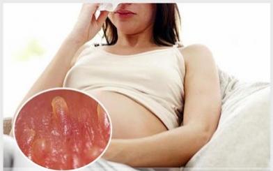 [ Giải Đáp ] Gai sinh dục ở phụ nữ mang thai có đáng lo ngại?