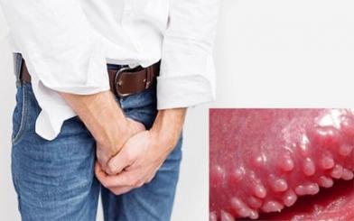 Gai sinh dục có tự khỏi được không? - Bác sĩ chuyên khoa giải đáp chi tiết