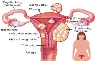 U xơ cổ tử cung : Nguyên nhân, triệu chứng và cách điều trị bệnh hiệu quả