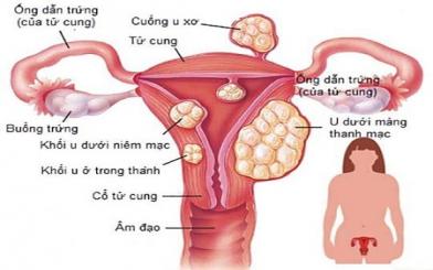 [ Giải Đáp ] 6 biểu hiện u xơ cổ tử cung thường gặp nhưng dễ bị bỏ qua