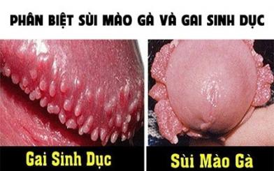 Cách để phân biệt sùi mào gà và gai sinh dục dễ dàng 