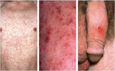 [ Giải Đáp ] Bệnh giang mai có chữa được không và bằng cách nào ?