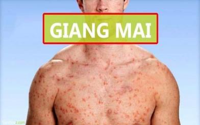 [ Giải Đáp ] Bệnh giang mai nam giai đoạn đầu có nguy hiểm không và chữa như nào f?