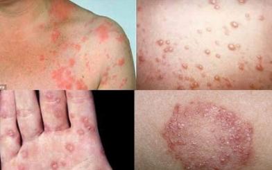 [ Giải đáp ] Bệnh giang mai có lây không và qua đường nào ?