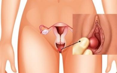 [ Giải Đáp ] Viêm tuyến bartholin sưng to có nguy hiểm không?