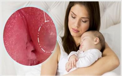 Viêm tuyến Bartholin khi cho con bú và cách điều trị hiệu quả