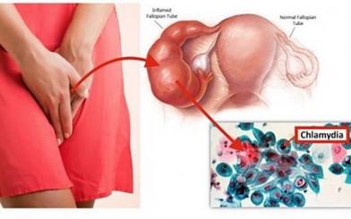 Chlamydia đường sinh dục là gì ? Nguyên nhân, triệu chứng và cách chữa