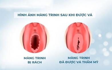 [ Giải Đáp ] Vá màng trinh có ảnh hưởng gì không và chữa ở đâu uy tín