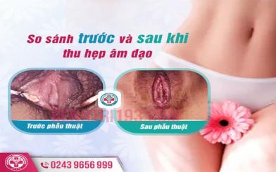 [ Thu nhỏ âm đạo sau sinh ] Thời điểm thích hợp và phương pháp hiện đại nhất