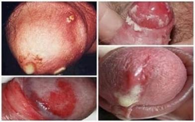 [ Review ] Kinh nghiệm chữa bệnh lậu trong vòng 2 tuần và chi phí thăm khám