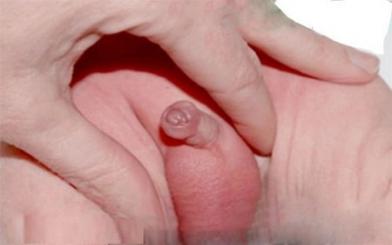 Viêm bao quy đầu ở trẻ em : Nguyên nhân, triệu chứng và cách điều trị hiệu quả
