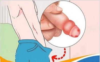 [ Tìm hiểu ]  10+ nguyên nhân viêm bao quy đầu phổ biến ở nam giới hiện nay