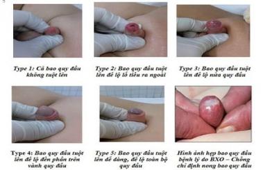 [ Review ] 10+ Dấu hiệu hẹp bao quy đầu ở trẻ dễ nhận biết nhất