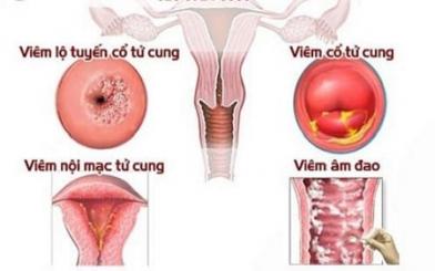 Viêm phụ khoa cấp độ 2 có nguy hiểm không ? 3 cách chữa hiệu quả