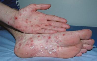 Bệnh giang mai giai đoạn 2 : Nguyên nhân, triệu chứng và cách điều trị hiệu quả