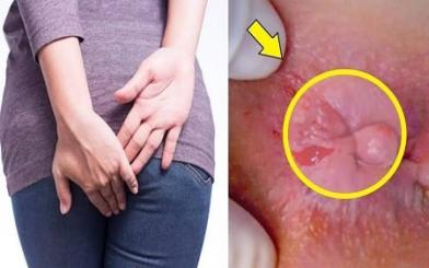 5+ Dấu hiệu bệnh trĩ ở nữ giới dễ nhận biết nhất hiện nay