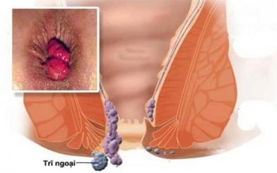 Búi trĩ ngoại là gì ? Triệu chứng nhận biết và các chữa hiệu quả