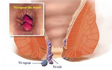 Trĩ ngoại tắc mạch : Nguyên nhân, triệu chứng và cách điều trị