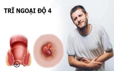 Tìm hiểu về Trĩ ngoại độ 4 và các dấu hiệu cần nhận biết