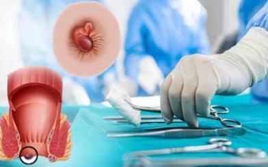 Tiểu phẫu trĩ ngoại : Quy trình và địa chỉ uy tín hiện nay