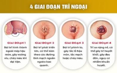 Đau trĩ ngoại do đâu mà ra và địa chỉ chữa uy tín tại Hà Nội