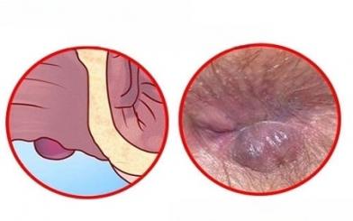 Những biểu hiện của bệnh trĩ ngoại độ 1 dễ nhận biết