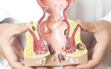Thuốc chữa trĩ ngoại độ 1 loại nào tốt và có hiệu quả hay không ?