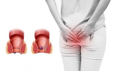 Cắt trĩ ngoại ở đâu tốt tại Hà Nội ?